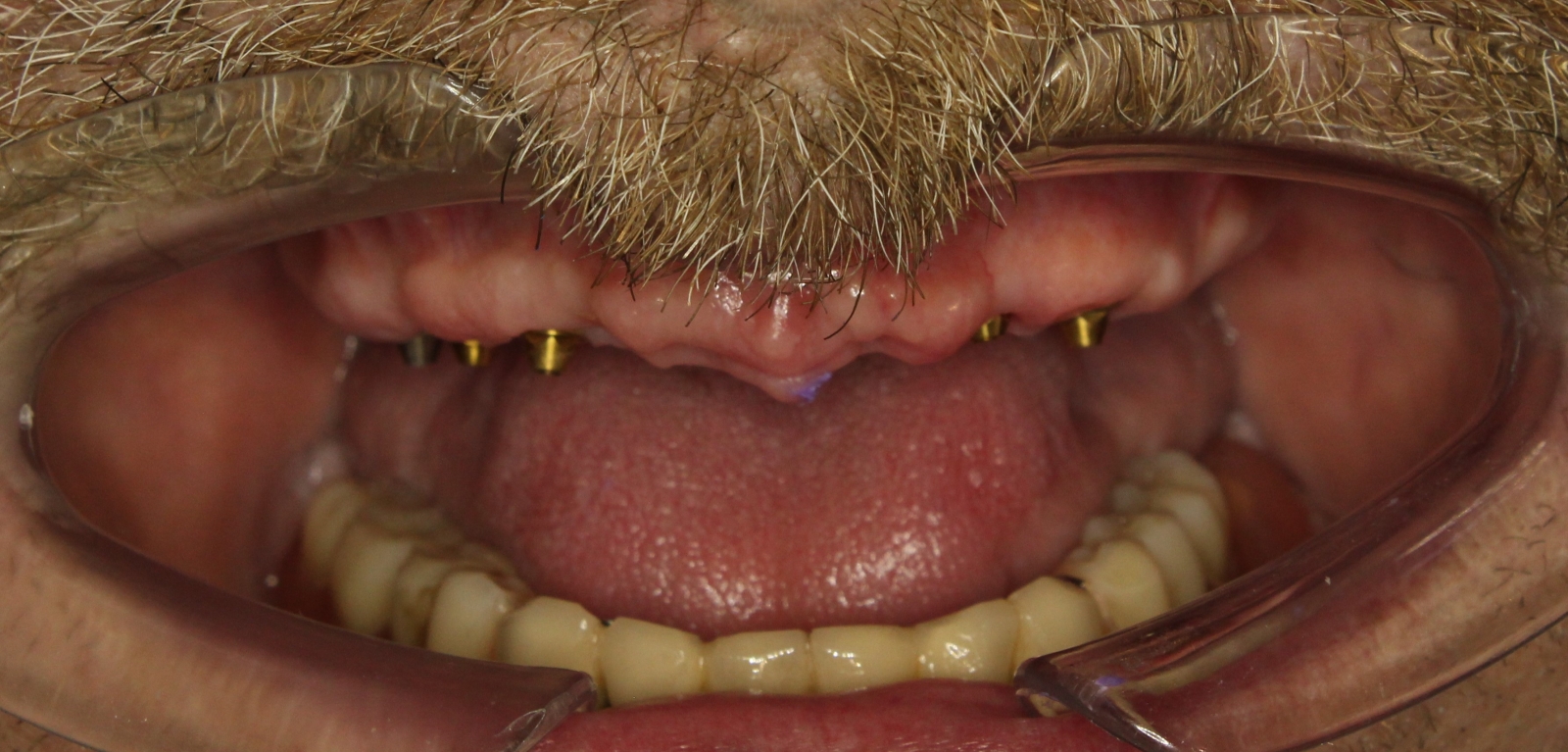 до Восстановление зубов на имплантах