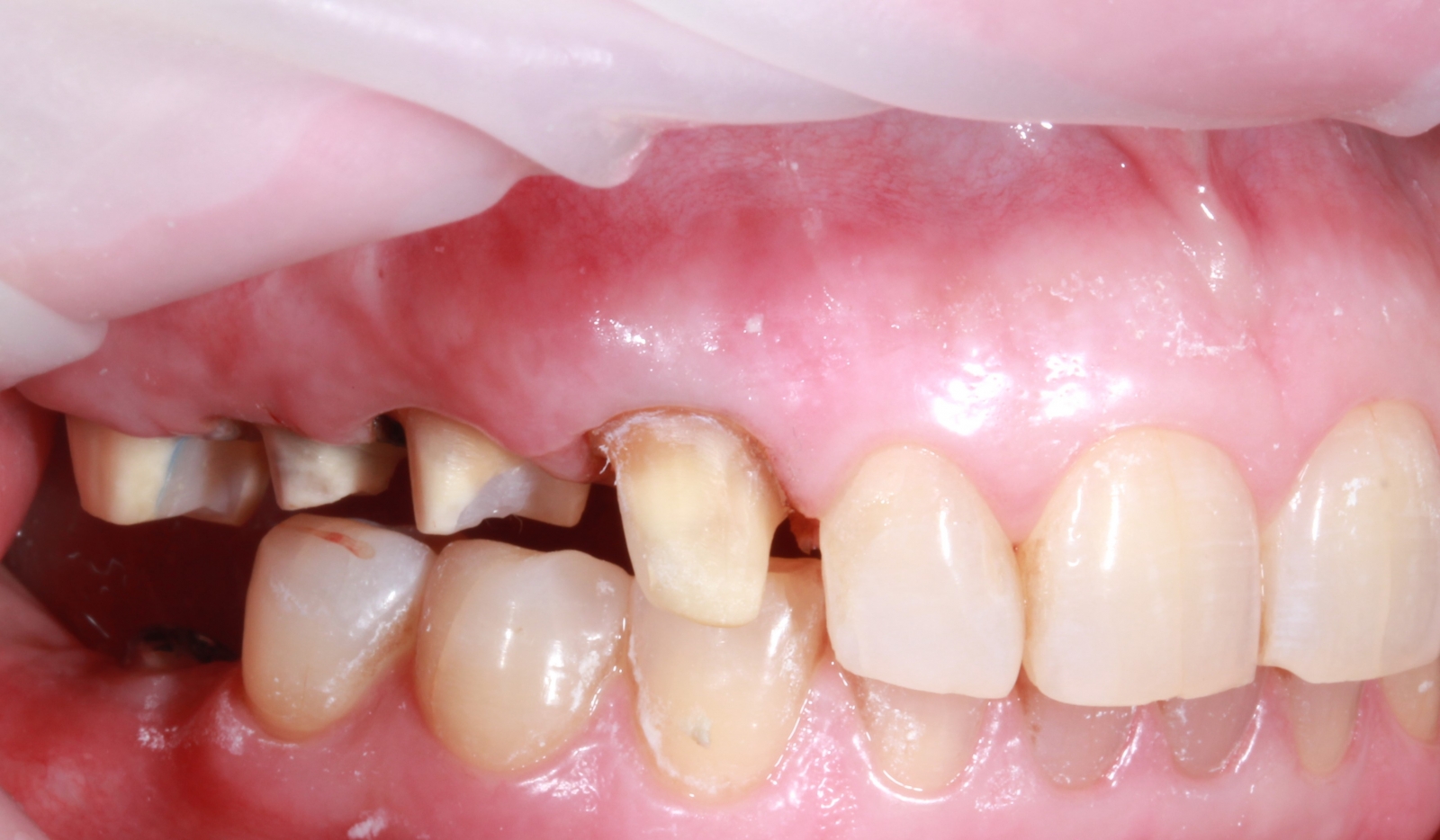 до Восстановление зубов коронками из диоксида циркония