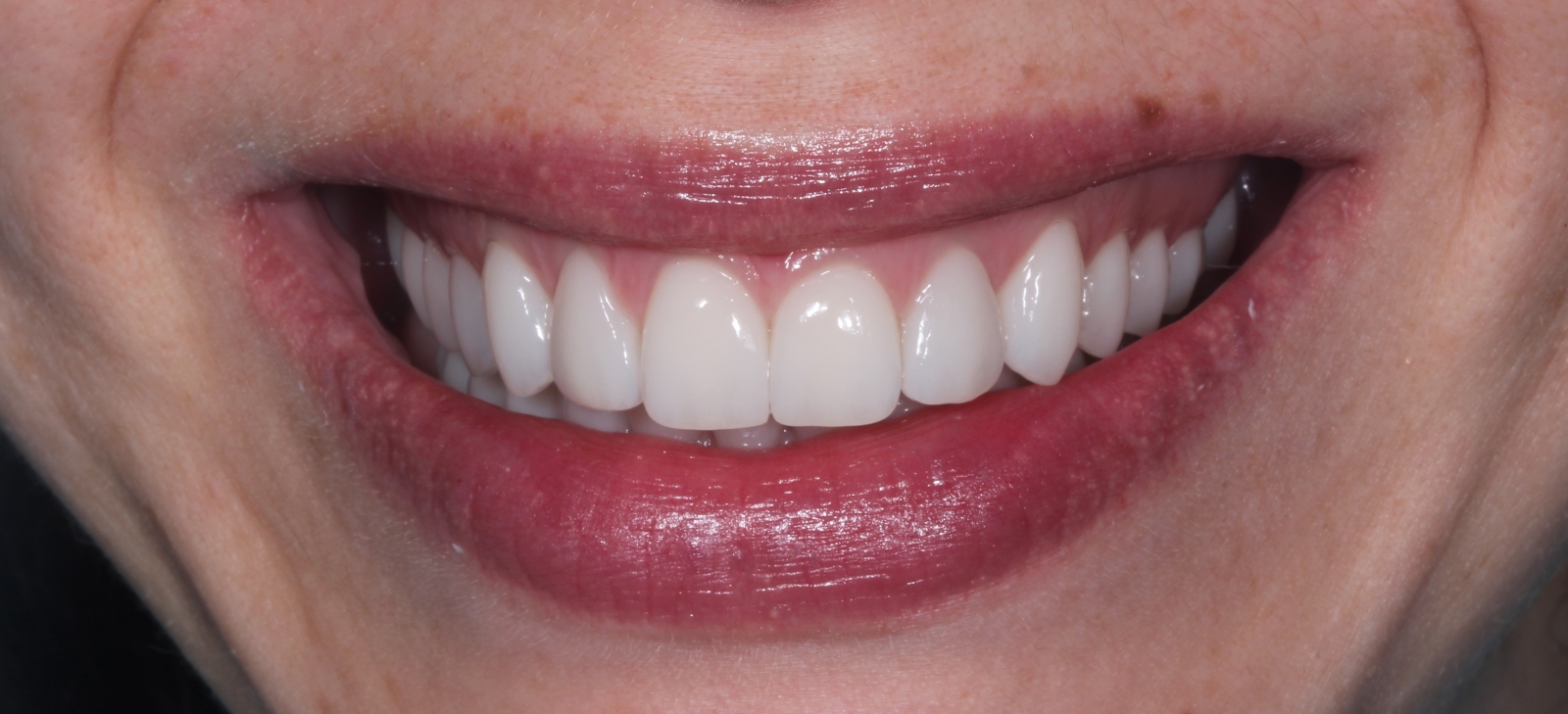 после Виниры