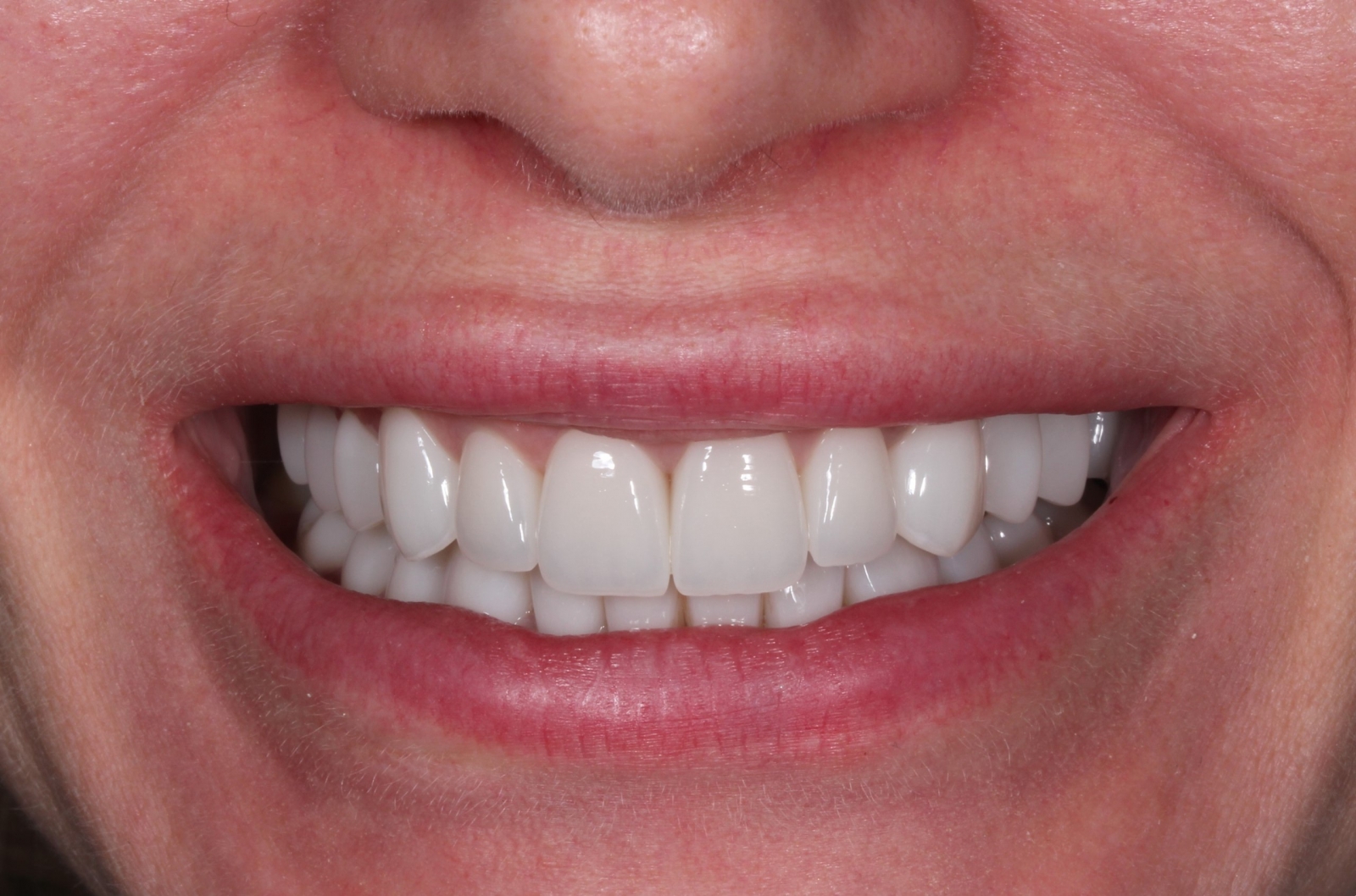 после Виниры