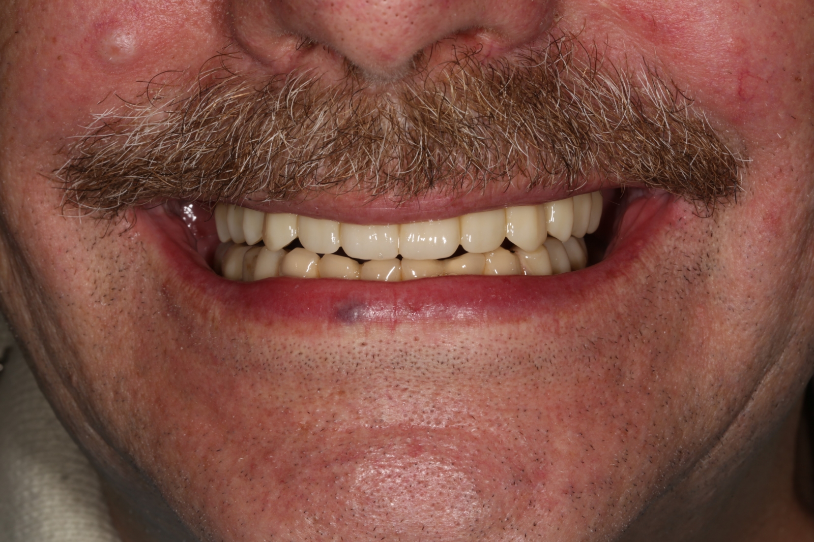 после Восстановление зубов на имплантах