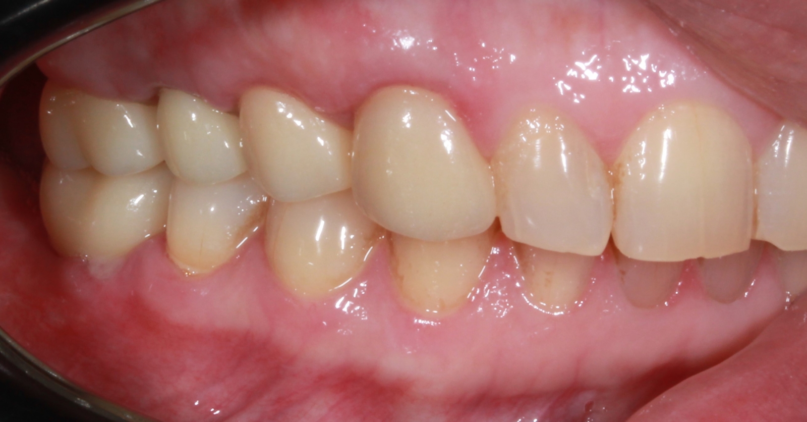 после Восстановление зубов коронками из диоксида циркония